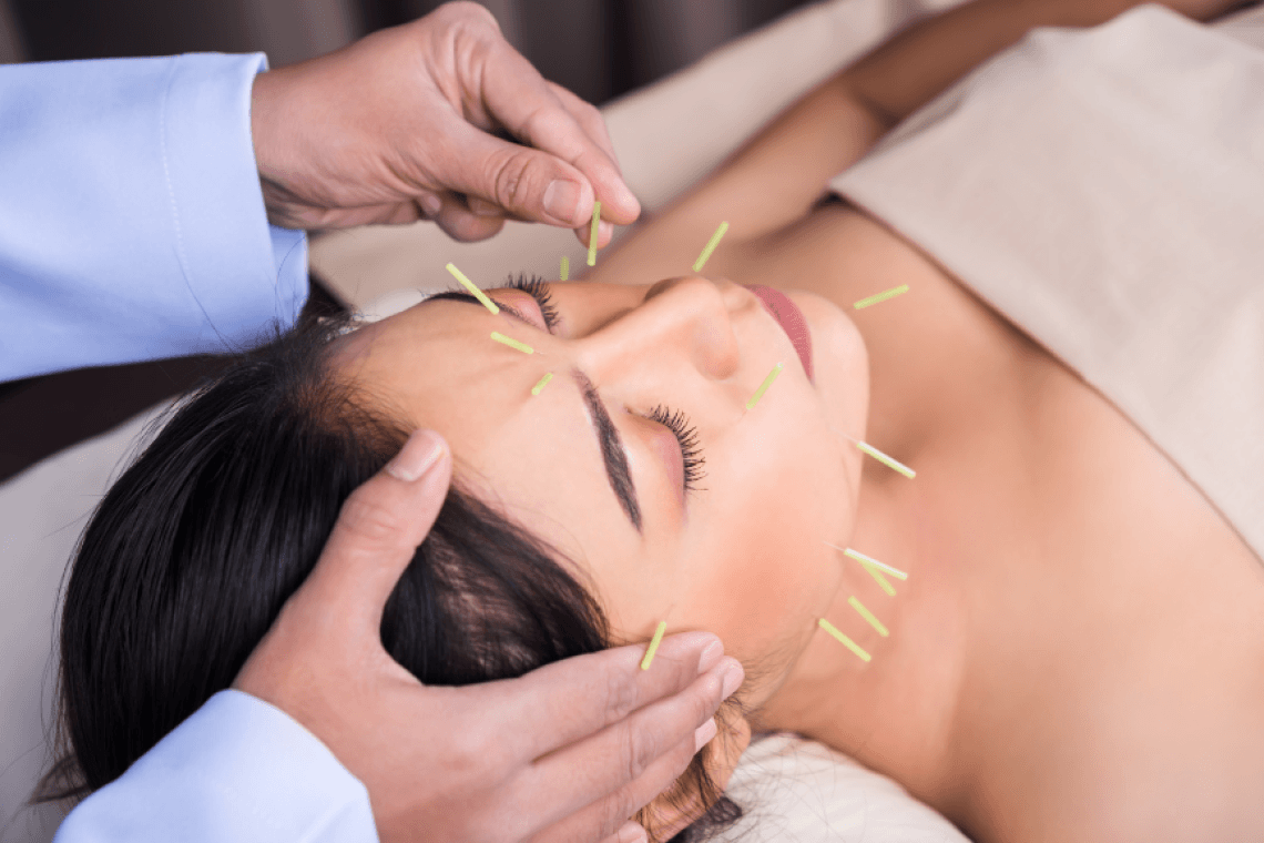 Acupuncture : quel remboursement par l'Assurance Maladie et les mutuelles ?